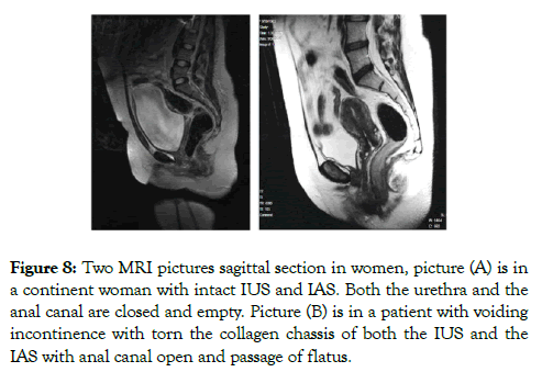 medical-surgical-urology-continent