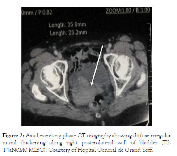 medical-surgical-urology-diffuse-irregular