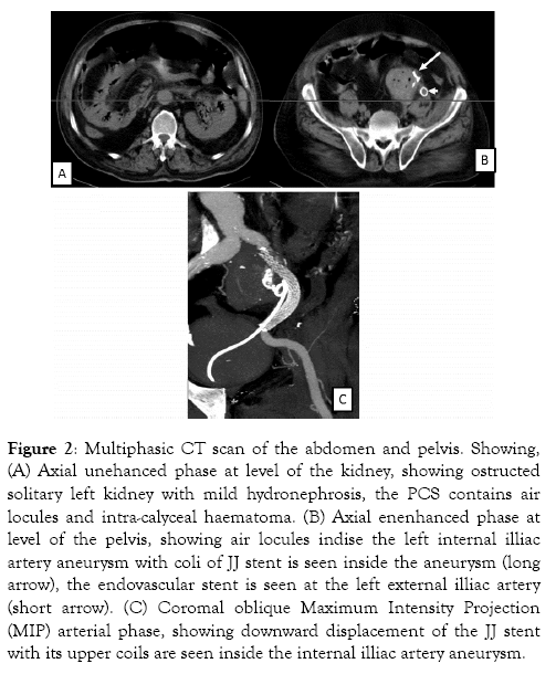 medical-surgical-urology-hydronephrosis