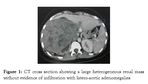 medical-surgical-urology-latero-aortic