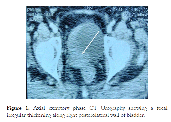 medical-surgical-urology-posterolateral-wall