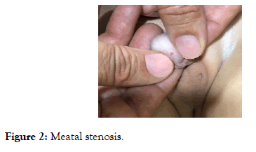 medical-surgical-urology-stenosis