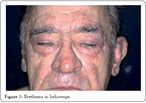 myalgias-and-polyarthralgias-heliotrope