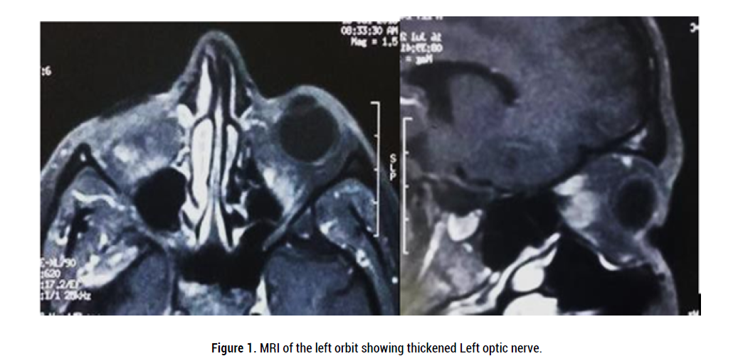 neurology-neurophysiology-Left-optic-nerve