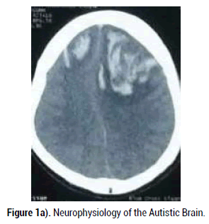 neurology-neurophysiology-autistic-brain