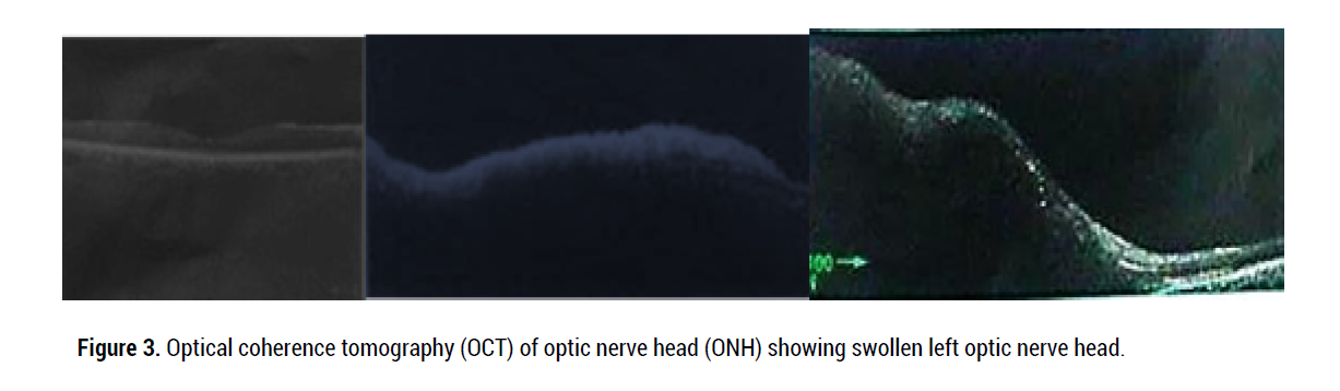 neurology-neurophysiology-coherence-tomography