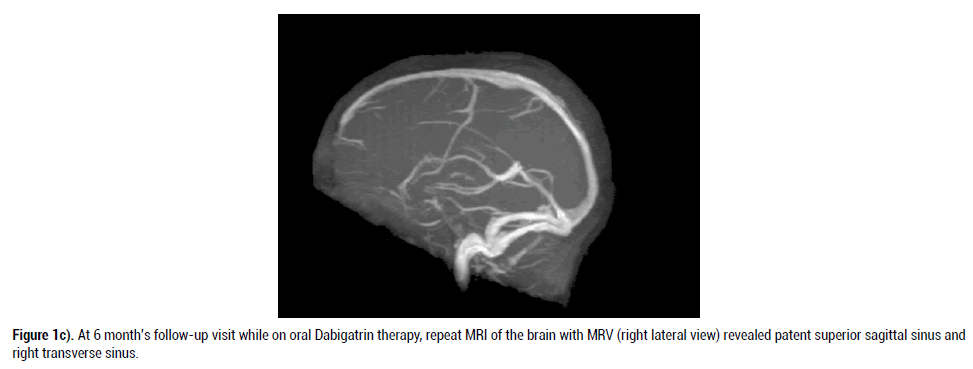 neurology-neurophysiology-dabigatrin-therapy