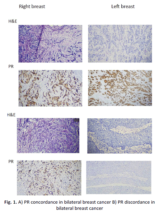 oncologyradiotherapy-bilateral