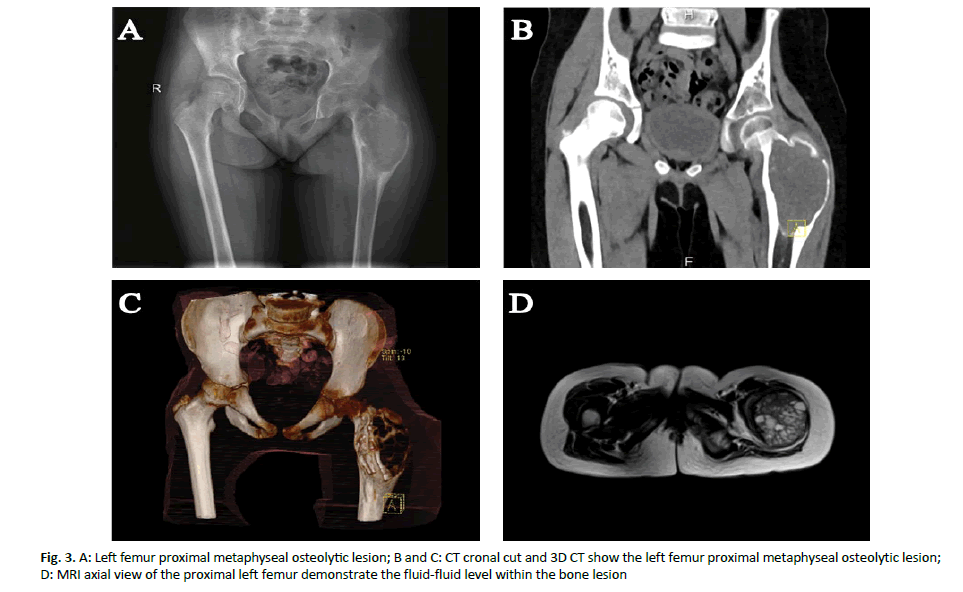 oncologyradiotherapy-osteolytic