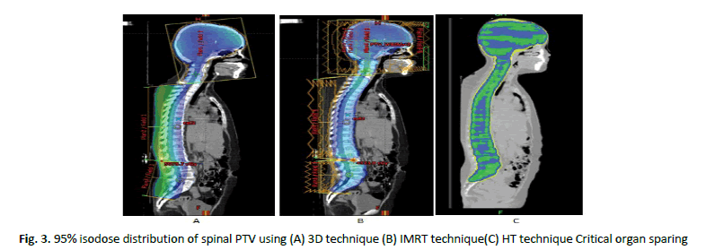 oncologyradiotherapy-spinal