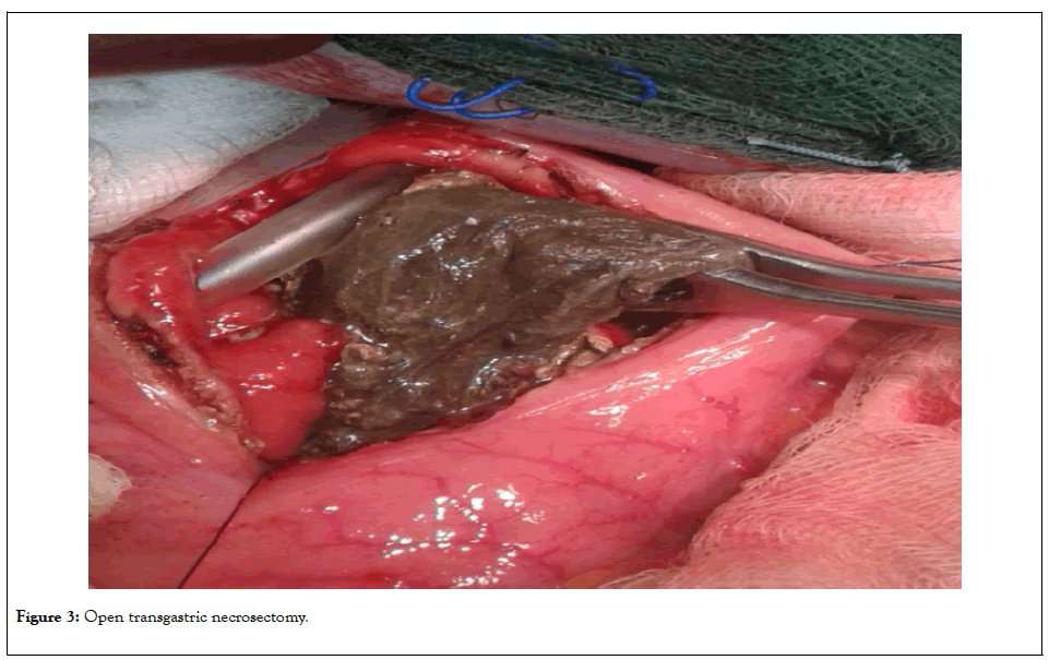 pancreatic-disorders-therapy-necrosectomy