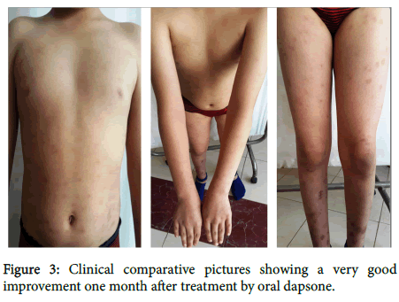 pediatrics-therapeutics-oral-dapsone