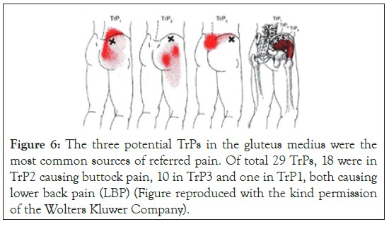 physical-medicine-gluteus