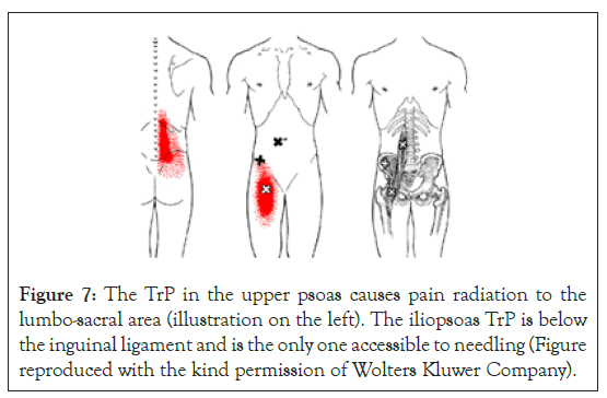 physical-medicine-psoas