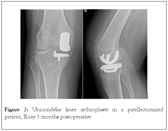 rheumatology-arthroplasty