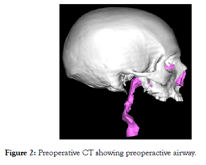 sleep-disorders-therapy-airway