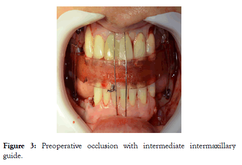 sleep-disorders-therapy-intermaxillary