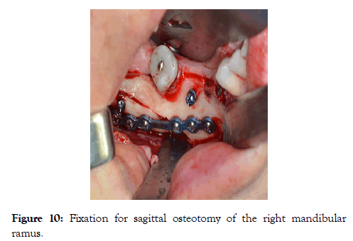 sleep-disorders-therapy-mandibular