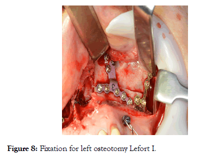 sleep-disorders-therapy-osteotomy