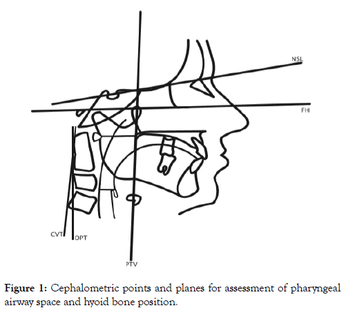 sleep-disorders-therapy-pharyngeal