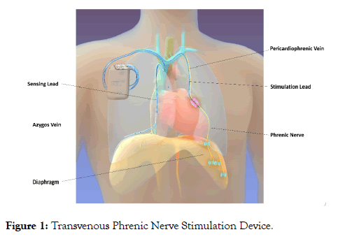 sleep-disorders-therapy-phrenic