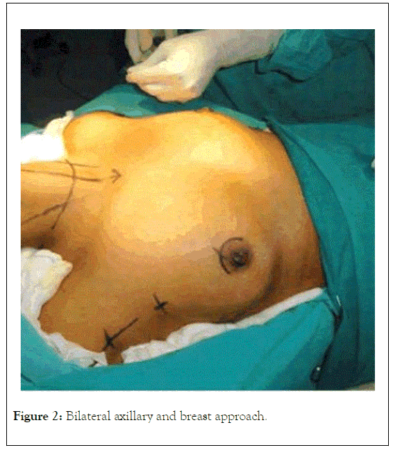 thyroid-disorders-therapy-axillary