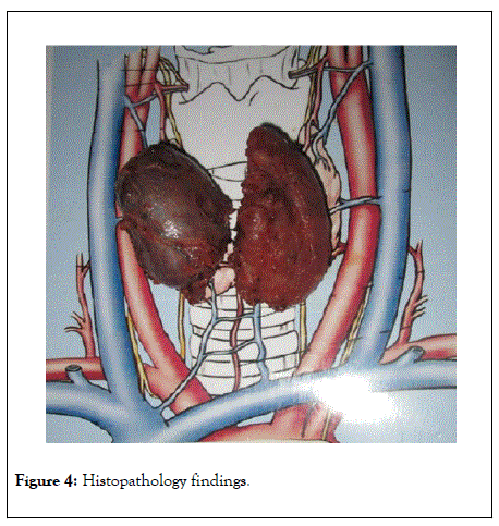 thyroid-disorders-therapy-findings