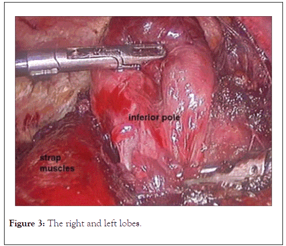 thyroid-disorders-therapy-lobes