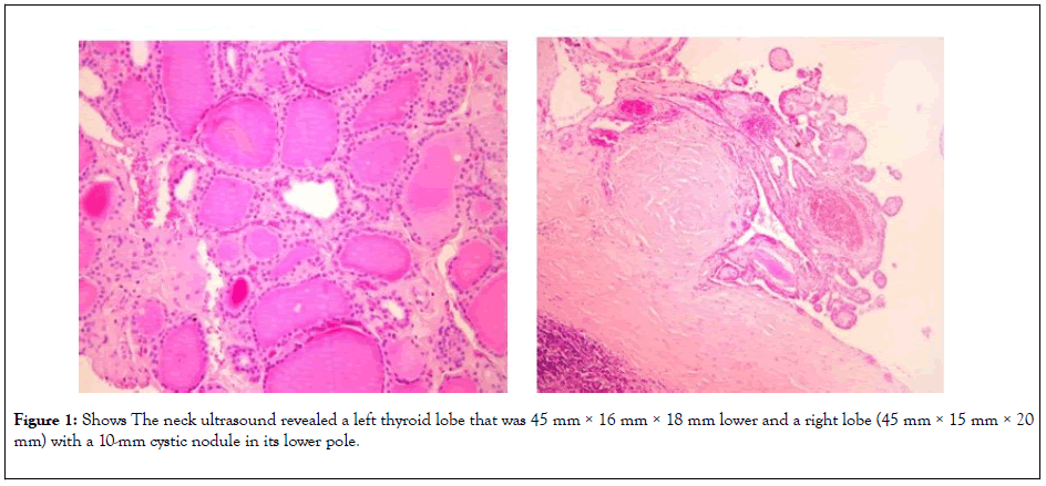 thyroid-disorders-therapy-neck