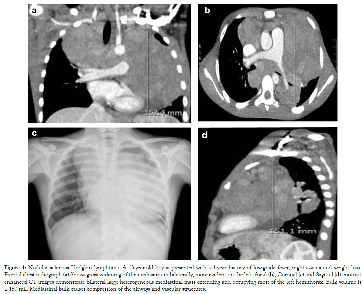 translational-medicine-Hodgkin-lymphoma