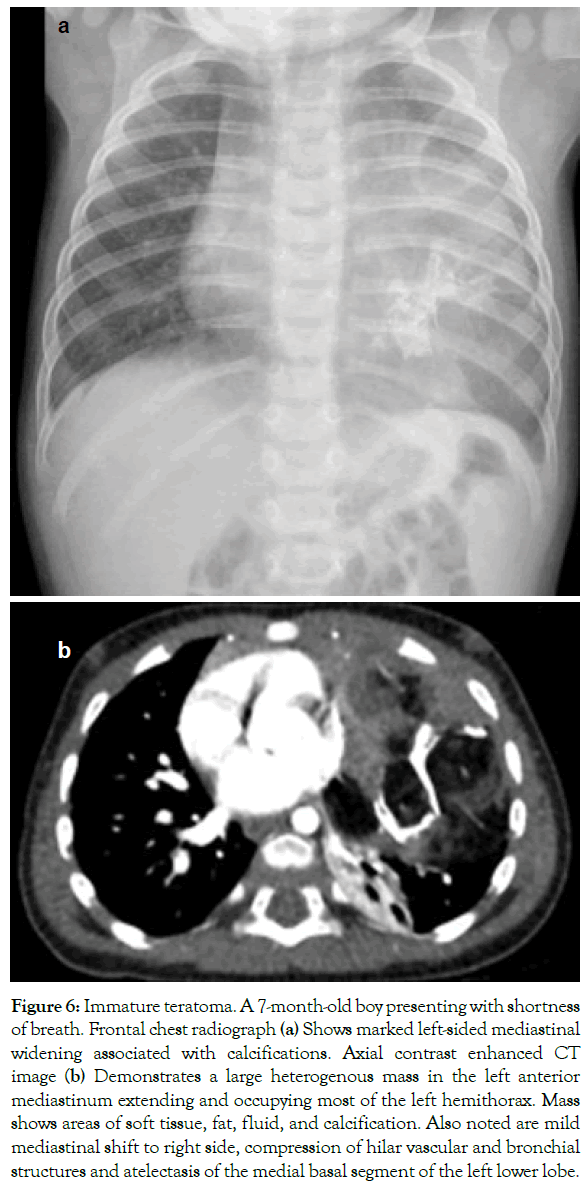 translational-medicine-Immature-teratoma