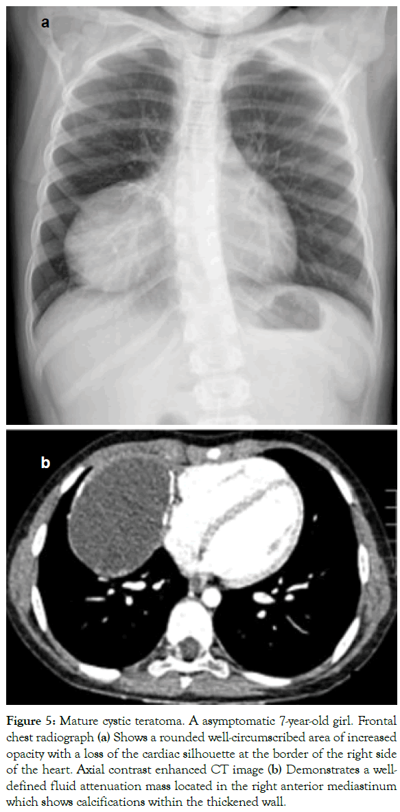 translational-medicine-Mature-cystic