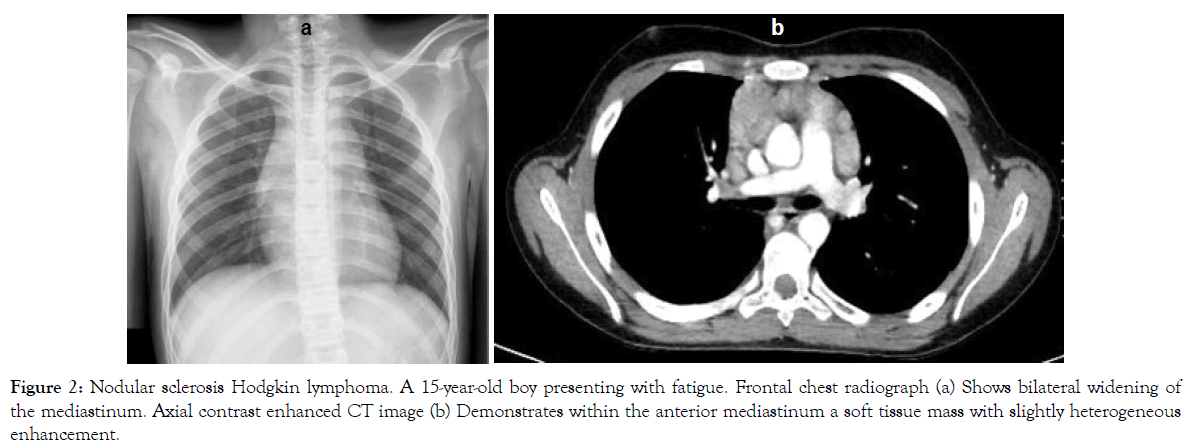 translational-medicine-Nodular-sclerosis