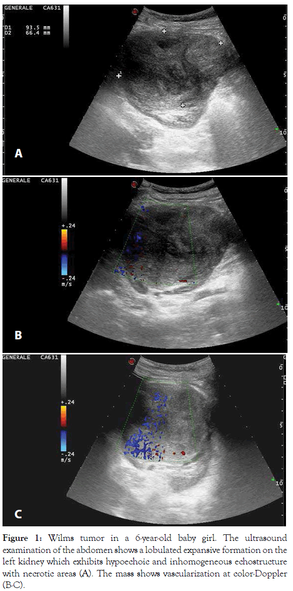 translational-medicine-Wilms-tumor