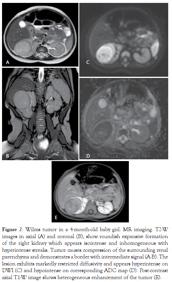 translational-medicine-Wilms-tumor