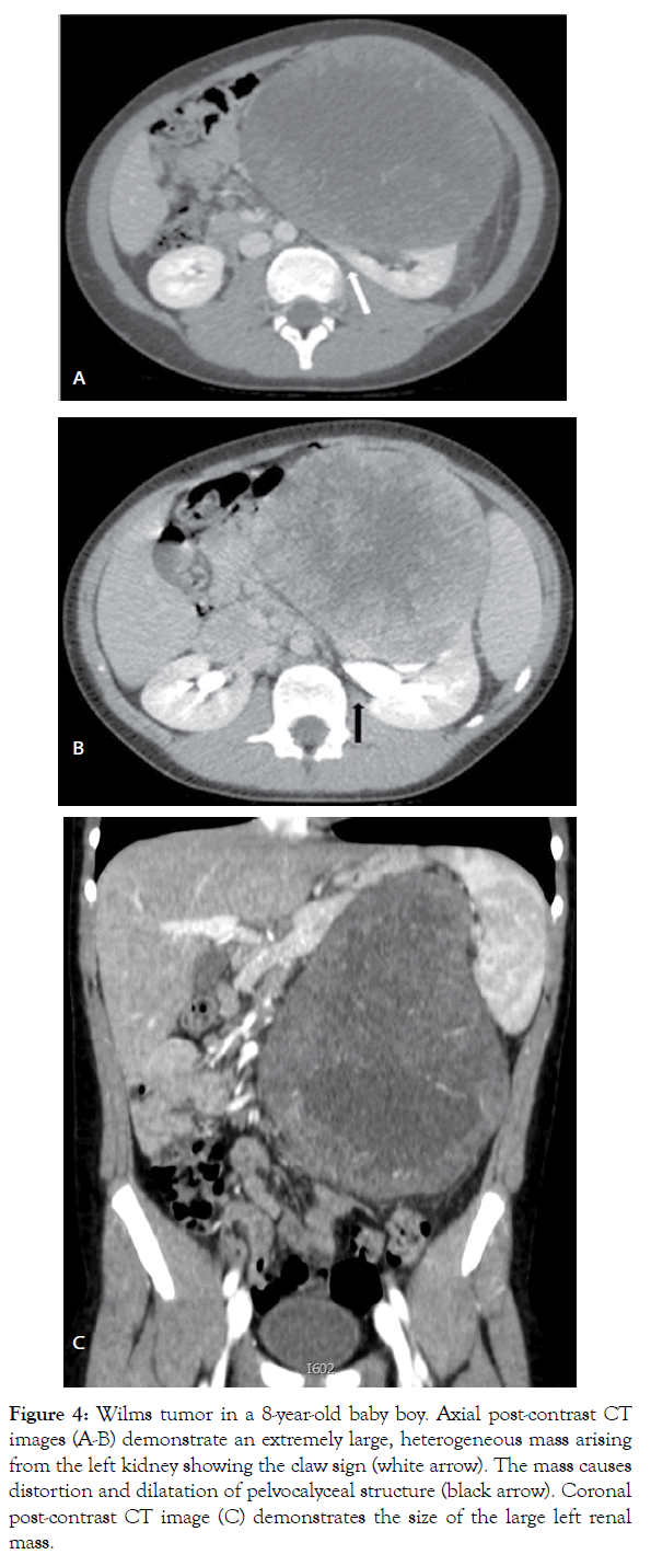 translational-medicine-Wilms-tumor