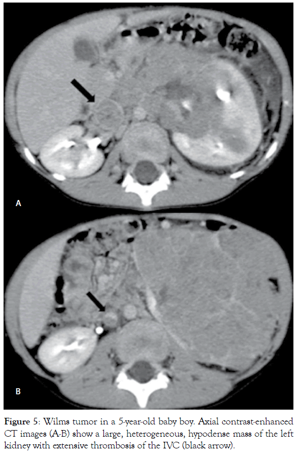 translational-medicine-Wilms-tumor