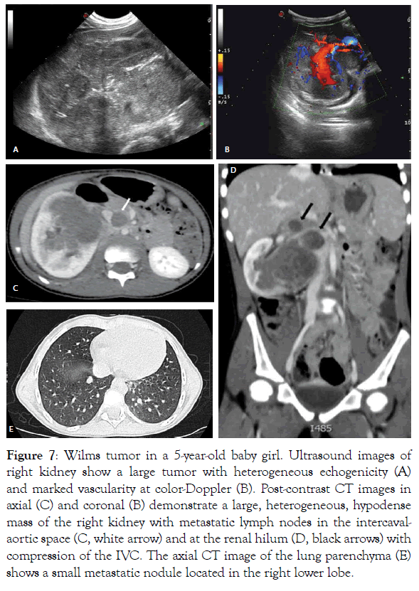 translational-medicine-Wilms-tumor