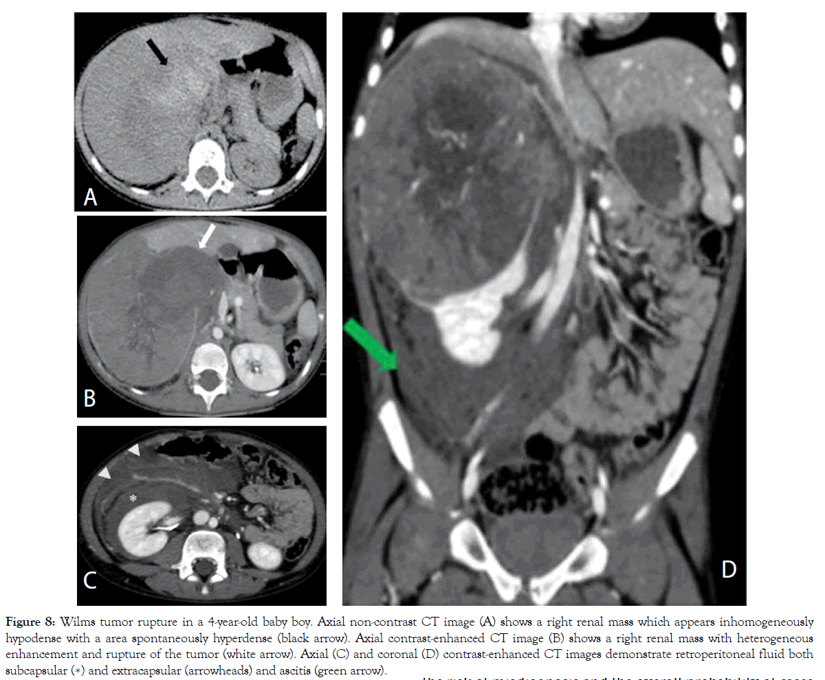 translational-medicine-Wilms-tumor