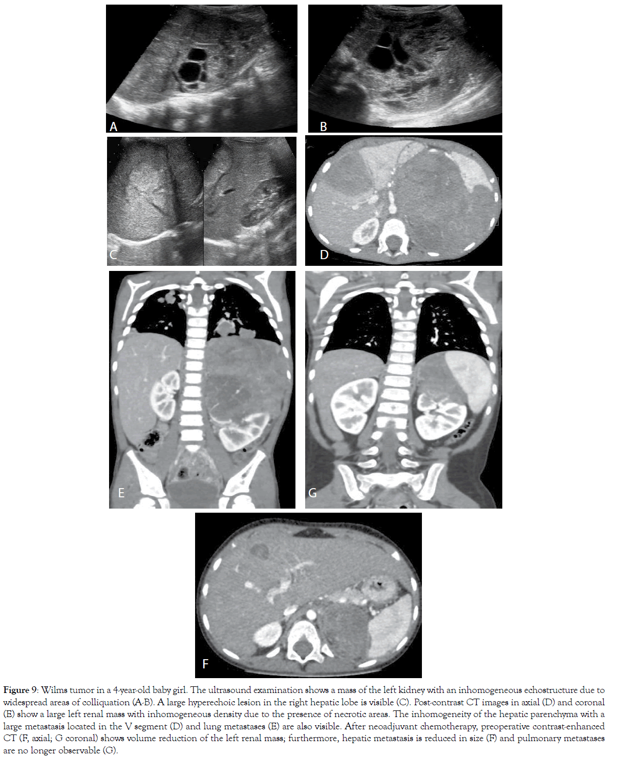 translational-medicine-Wilms-tumor