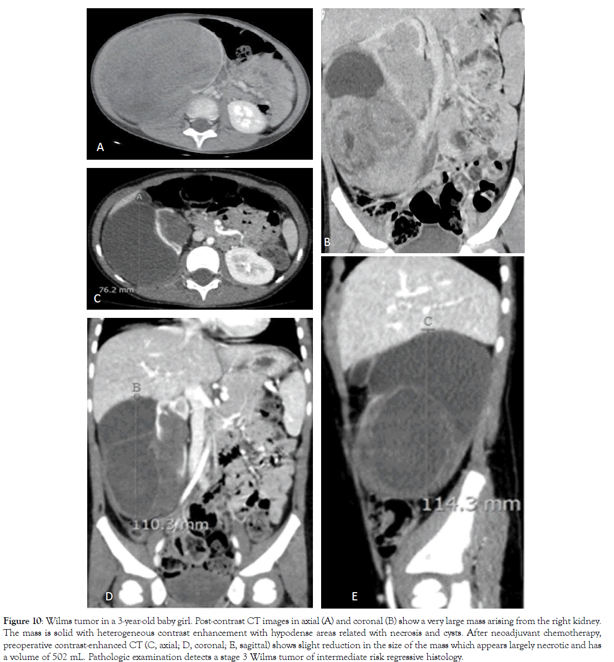 translational-medicine-Wilms-tumor