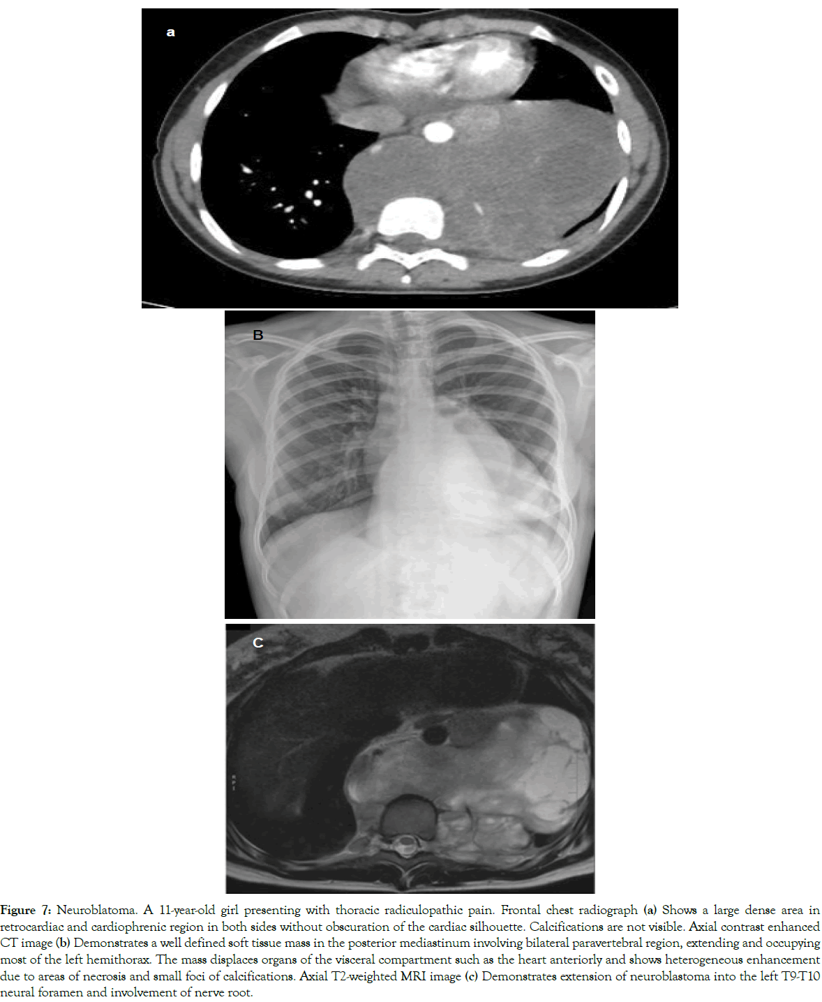 translational-medicine-radiculopathic