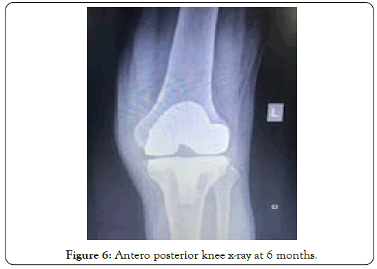 tuberculous-arthritis-diagnosed-antero-posterior