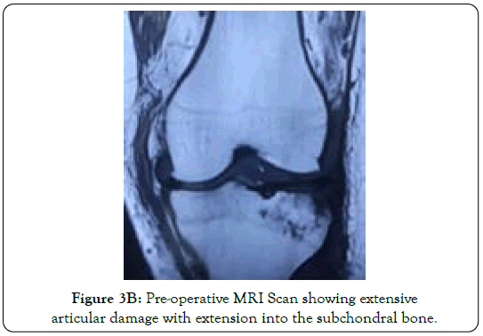 tuberculous-arthritis-diagnosed-extensive-articular-damage