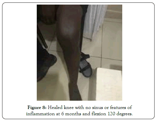 tuberculous-arthritis-diagnosed-healed-knee