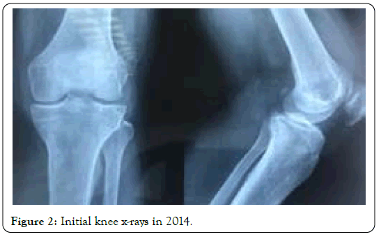 tuberculous-arthritis-diagnosed-knee-x-rays