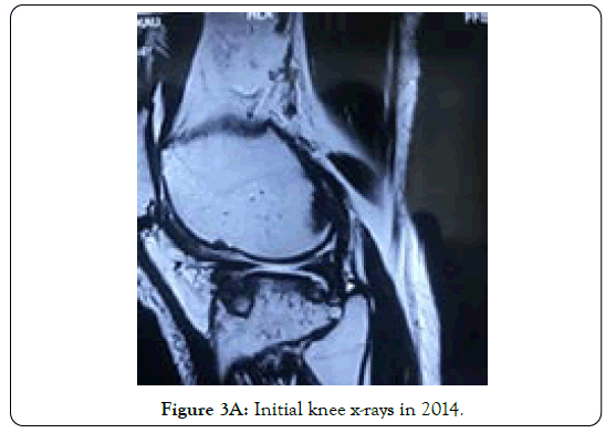 tuberculous-arthritis-diagnosed-knee-x-rays-in-2014