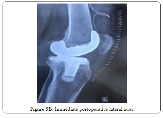 tuberculous-arthritis-diagnosed-lateral-x-ray