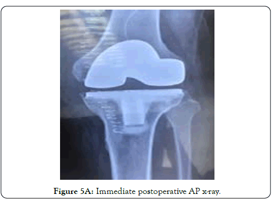 tuberculous-arthritis-diagnosed-postoperative