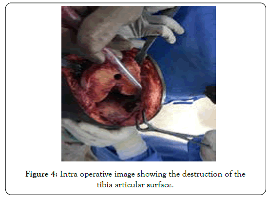 tuberculous-arthritis-diagnosed-tibia-articular-surface